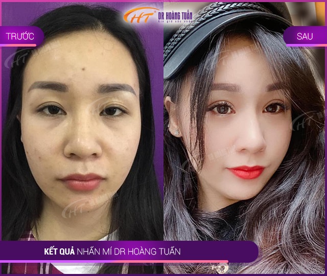 Kết quả bấm mí tại Thẩm mỹ Hoàng Tuấn